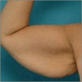 Brachioplasty (Arm Lift) Before