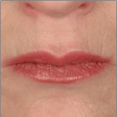 Injectable Fillers After