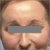 Laser Facial Resurfacing After
