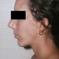 Chin Augmentation After