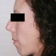 Chin Augmentation Before