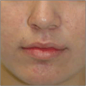 Acne Treatments After
