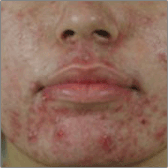 Traitements anti-acné Avant