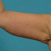 Brachioplasty (Arm Lift) After