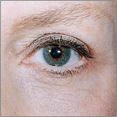 Blepharoplasty After