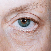 Blepharoplasty Before