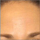 Botox® Injection After