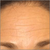 Botox® Injection Before