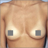 Breast Augmentation Before