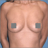 Breast Lift After