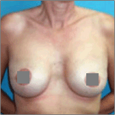 Breast Reconstruction After