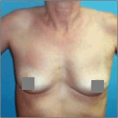 Breast Reconstruction Before