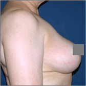 Breast Reduction After