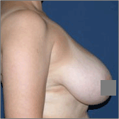 Réduction mammaire Avant