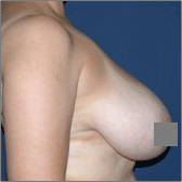 Breast Reduction Before