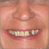 Dental Bridge Before