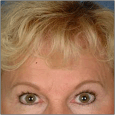 Brow Lift After