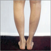 Calf Implants Before