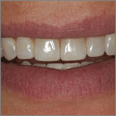 Cosmetic Tooth Contouring After