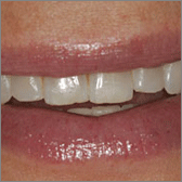 Cosmetic Tooth Contouring Before