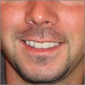 Implants dentaires Après