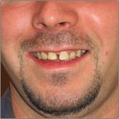 Implants dentaires Avant