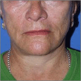 Redrapage chirurgical du visage et du cou Après