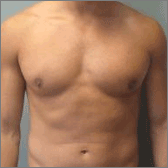 Gynécomastie (réduction mammaire chez les hommes) Après