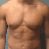 Gynécomastie (réduction mammaire chez les hommes) Avant