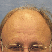 Hair Transplant Before