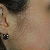 Laser Hair Removal Before