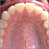 Invisalign® After