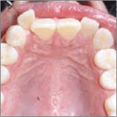 Invisalign® Before