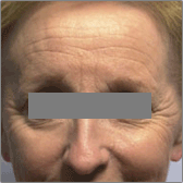 Relissage du visage au laser Avant