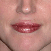 Augmentation des lèvres Après