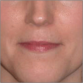 Lip Augmentation Before