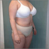 Liposuction After
