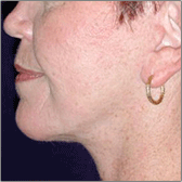 Neck Lift After
