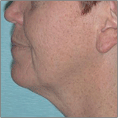 Neck Lift Before