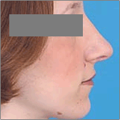 Rhinoplastie Après