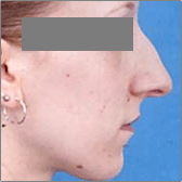 Rhinoplastie Avant