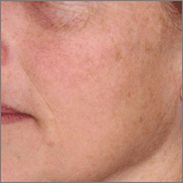 Laser Skin Resurfacing After