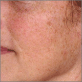 Laser Skin Resurfacing Before