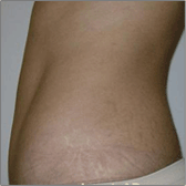 Tummy Tuck (Abdominoplasty) After