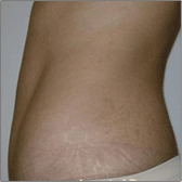 Abdominoplastie Après