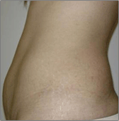 Abdominoplastie Avant