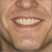 Teeth Whitening Before