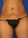 Tummy Tuck in Langley & Vancouver Metro, Plastic Surgeon, Dr. Mosher